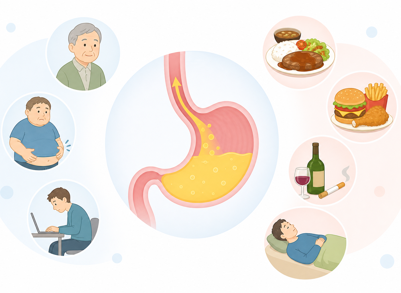 逆流性食道炎の原因